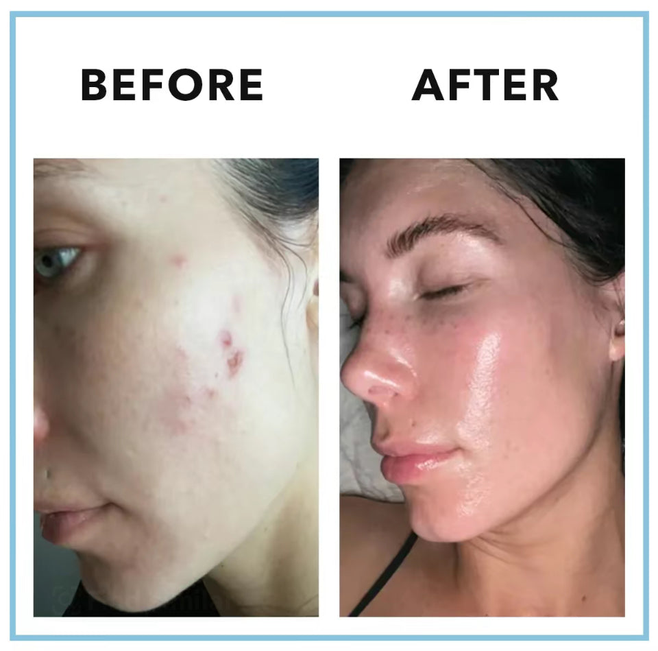 Crafted™ Acne Vitamin